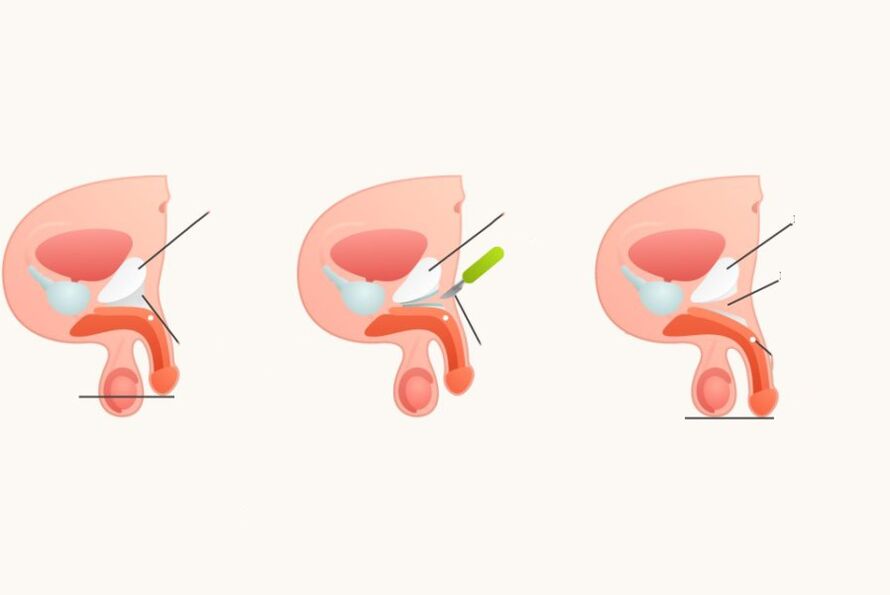 Ligamentotomie, um den Penis zu erhöhen