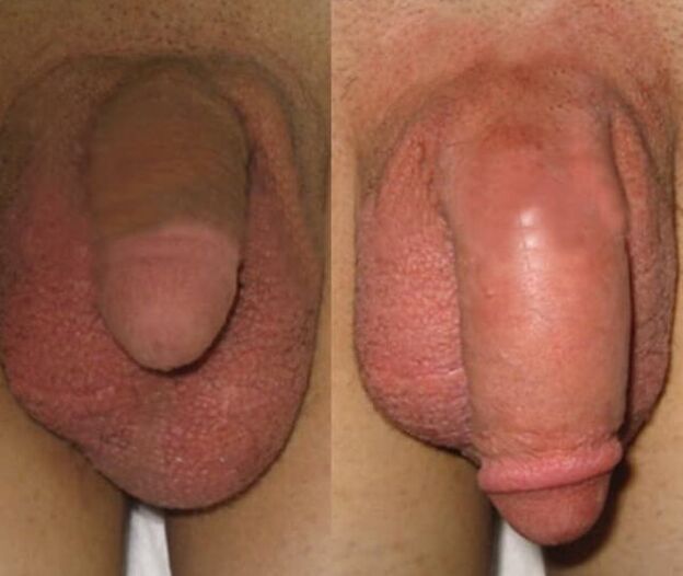 Das Ergebnis der Installation einer Kollagenmatrix im Penis