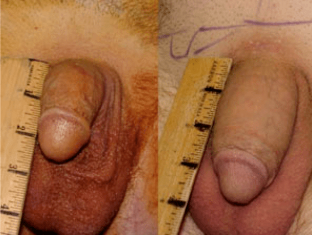 Vor und nach Lipofilling und Gelimplantation